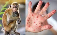 Bệnh đậu mùa khỉ là gì? Dấu hiệu nhận biết bệnh đậu mùa khỉ như thế nào? Biện pháp phòng ngừa bệnh đậu mùa khỉ?